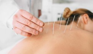 acupuncture